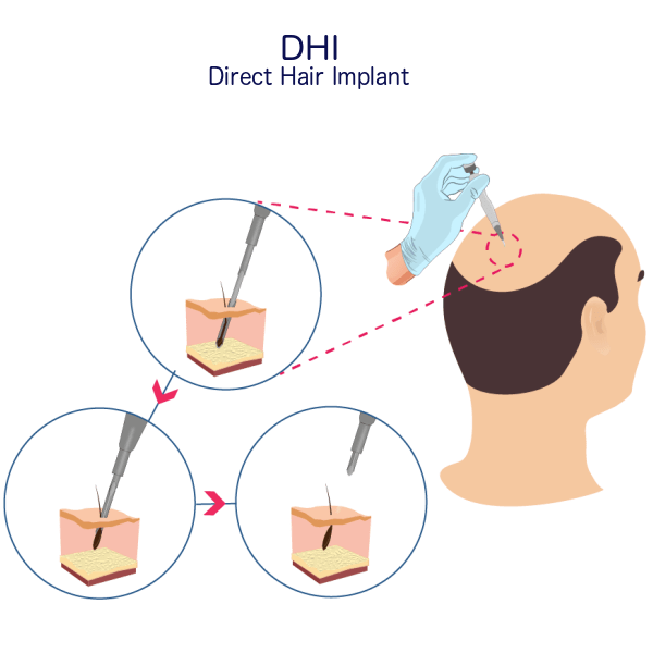 DHI Hair Transplant Procedure