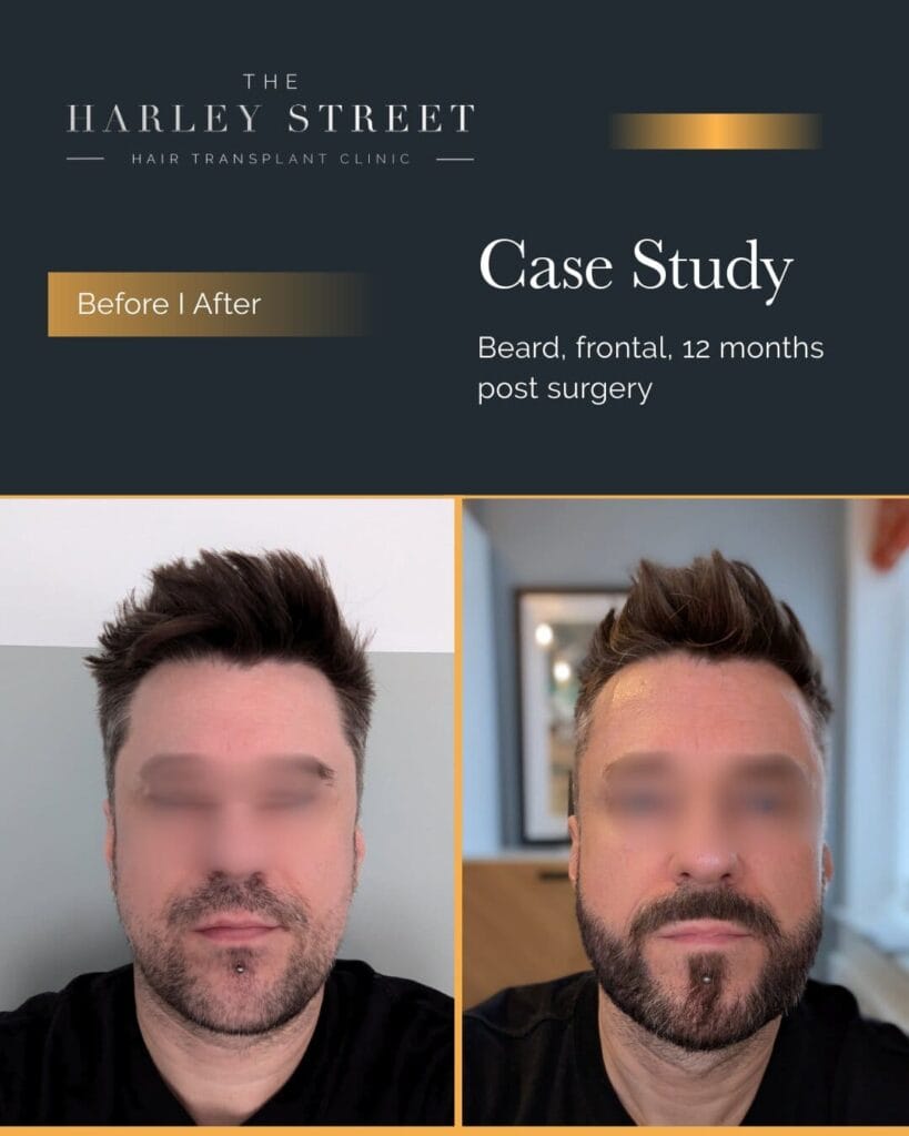 Beard Transplant Harley-Street-HT-Patient-Beard-P-Burley-frontal