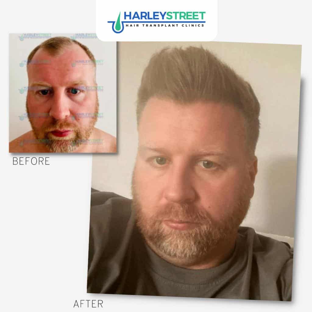 Before & After Results Harley-Street-Hair-Transplant-Clinics-patient-Aaron-before-and-after-1